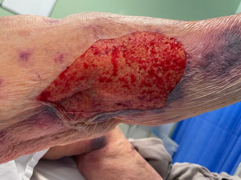 How To Treat Skin Tears In The Elderly